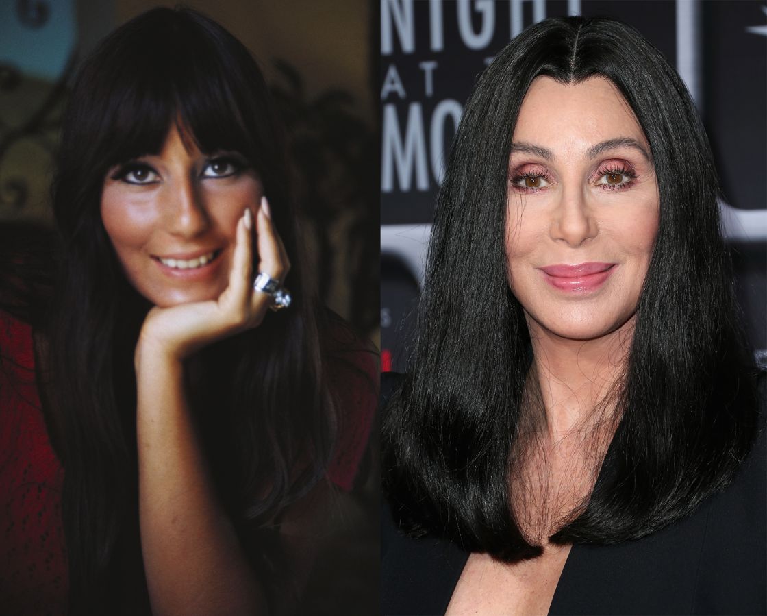 Cher Plastic Surgery